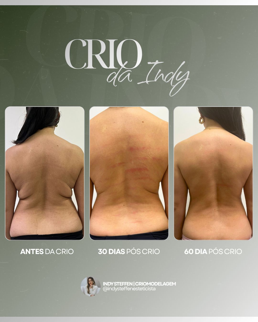 Método Crio da Indi - Caso 3